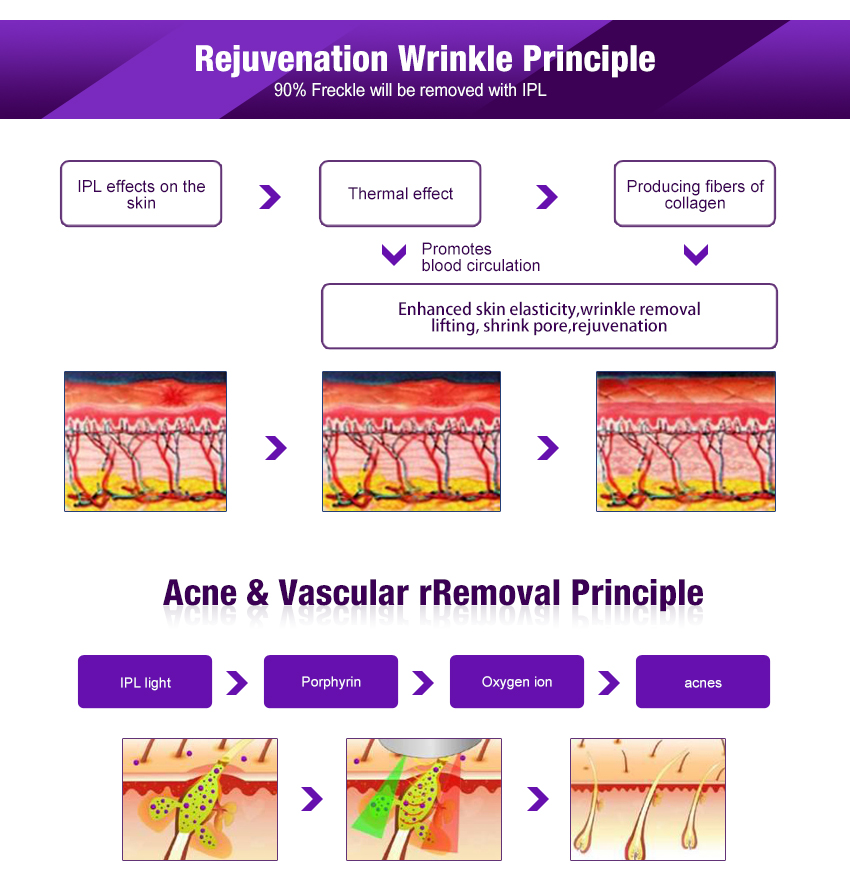 laser ear hair removal
