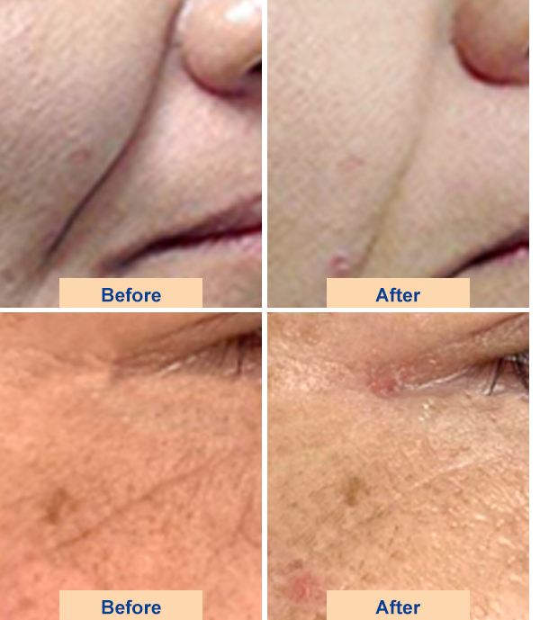 ulthera hifu machine