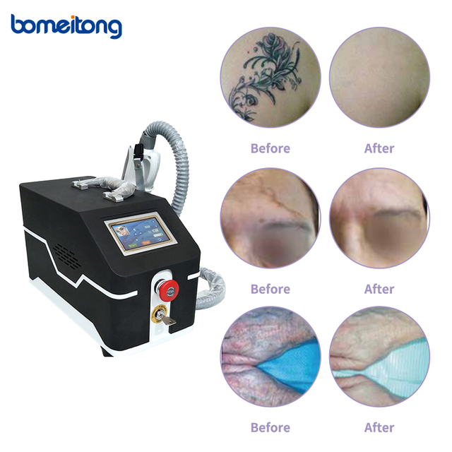 Laser Scar Removal Tattoo Eraser Picosure Laser Machine