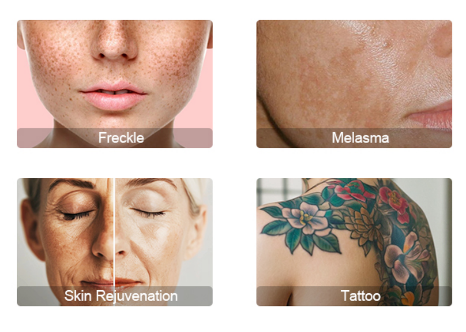 laser tattoo removal device