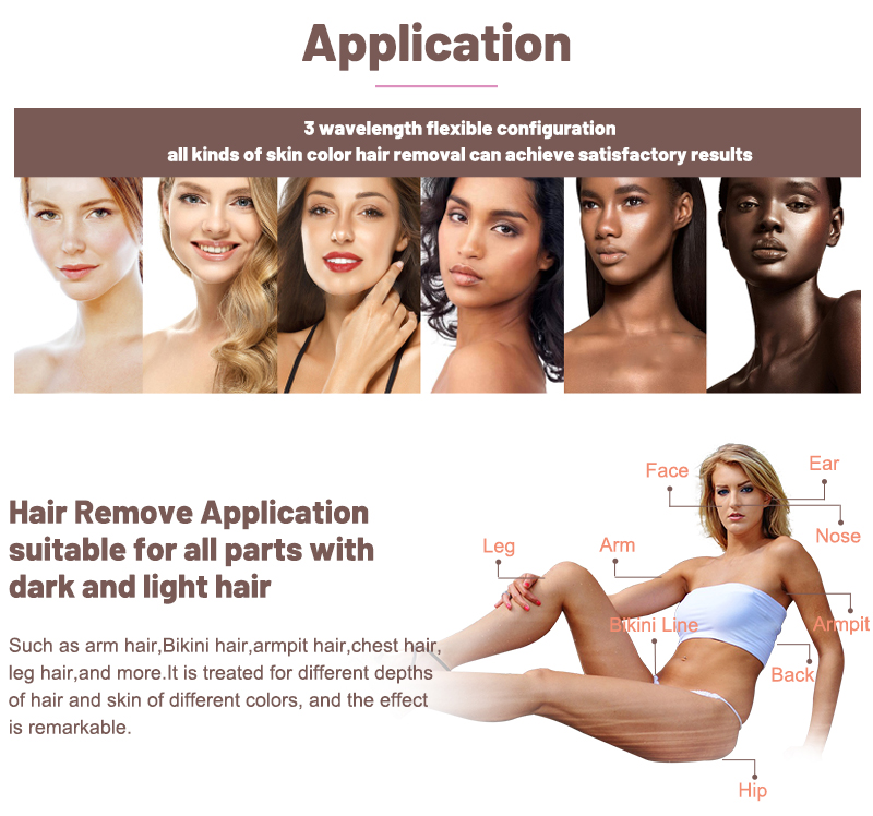 diode laser hair removal 