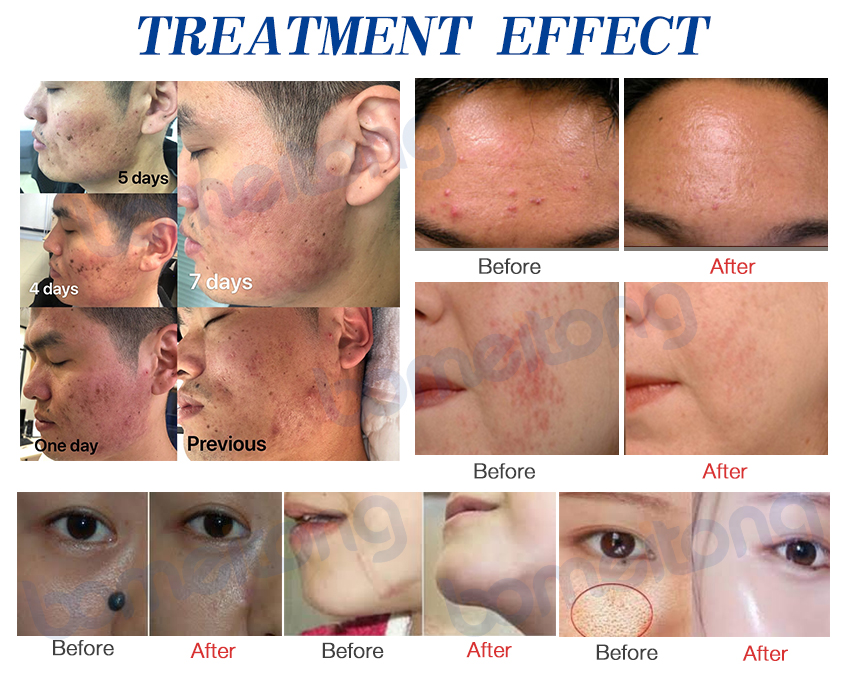 co2 fractional laser equipment