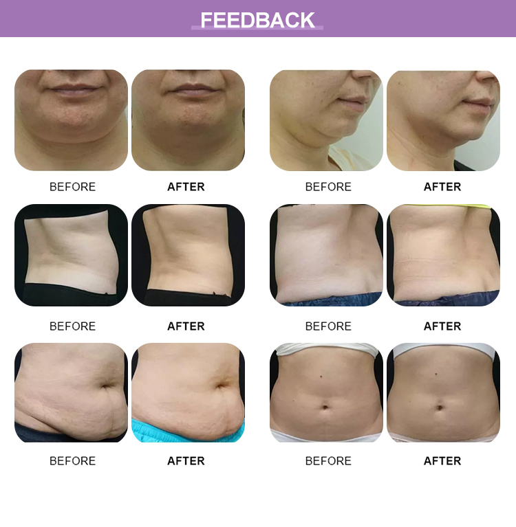 Fat freezing machine