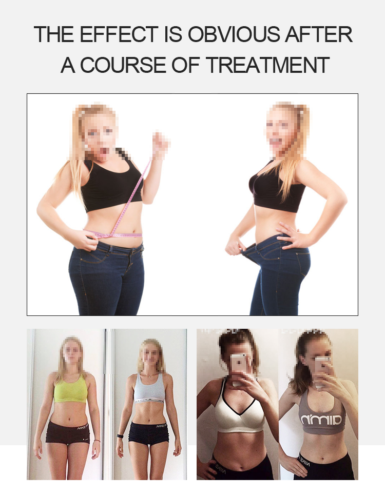 laser fat sculpting