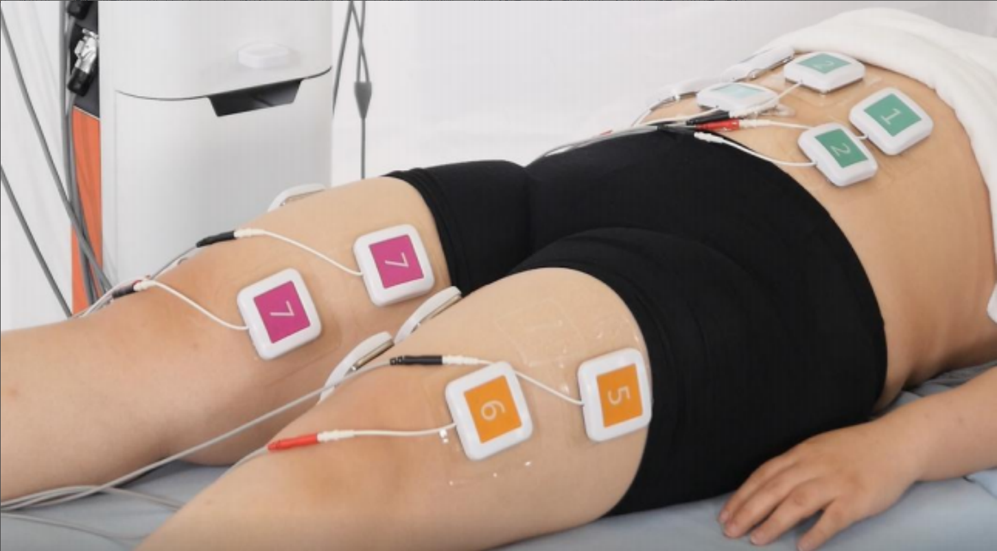 trusculpt flex treatment