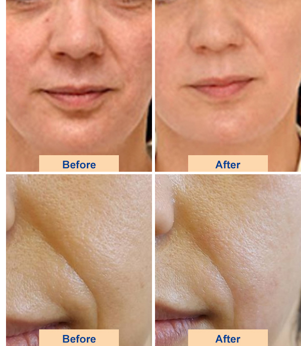 hifu face lifting machine