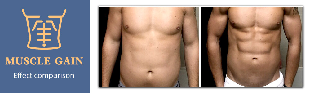 emsculpt muscle building