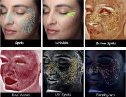 skin analysis