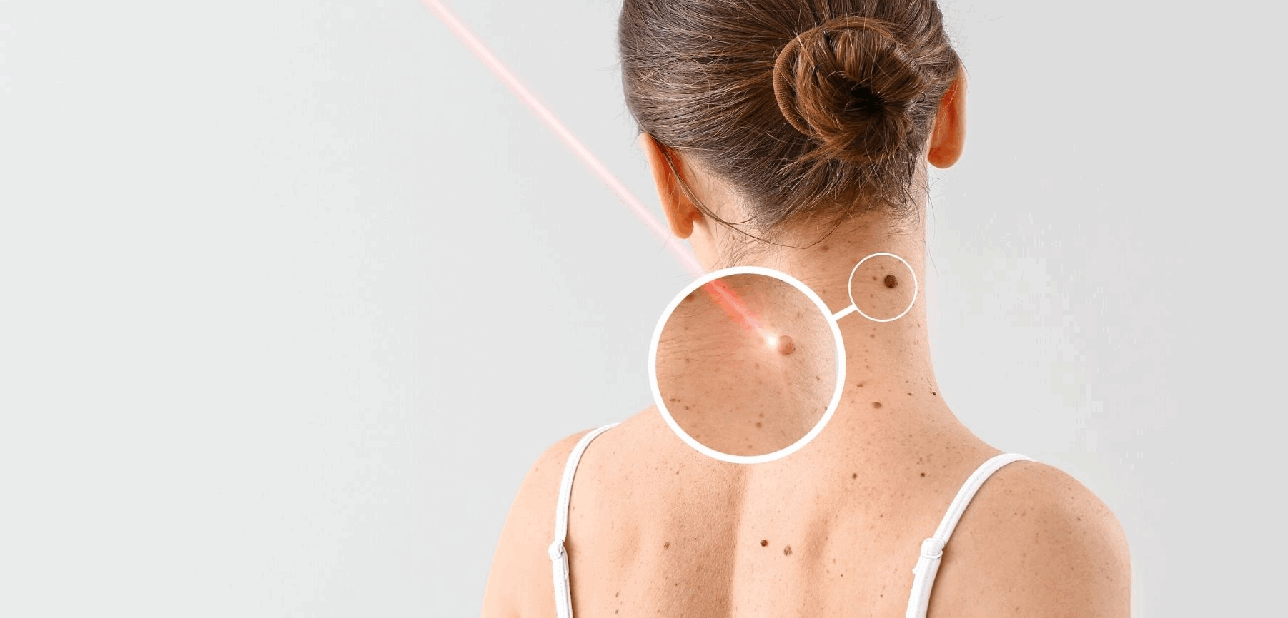 What Preparations Should Be Made before And After Picosecond Laser Treatment?