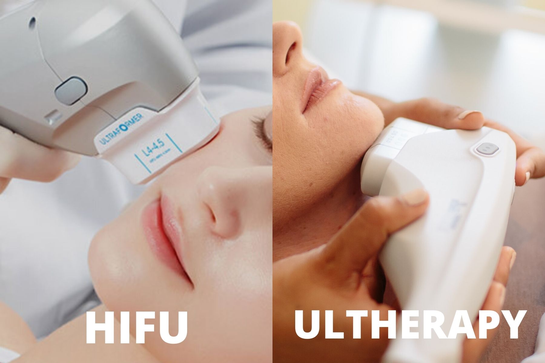 HIFU-vs-Ultherapy