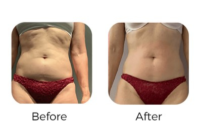 Ems Body Sculpt Machine