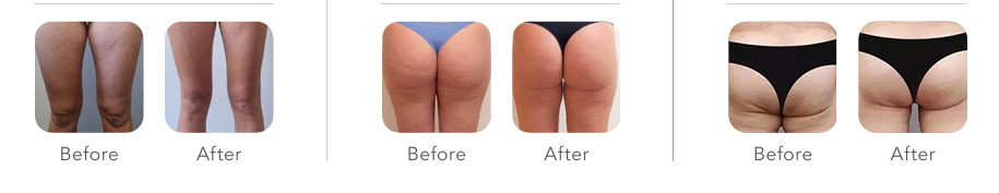 body sculpting before and after