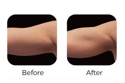 Multi-Sculpt Body Sculpting