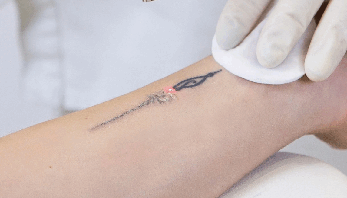 Why Is Picosecond Laser An Ideal Choice for Tattoo Removal?