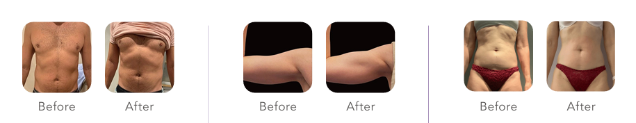 body sculpting before and after