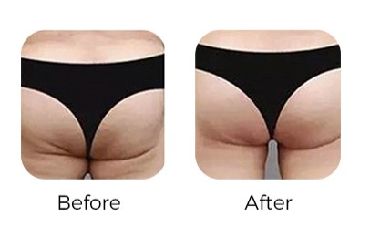 HIEMT Musculpting pro machine