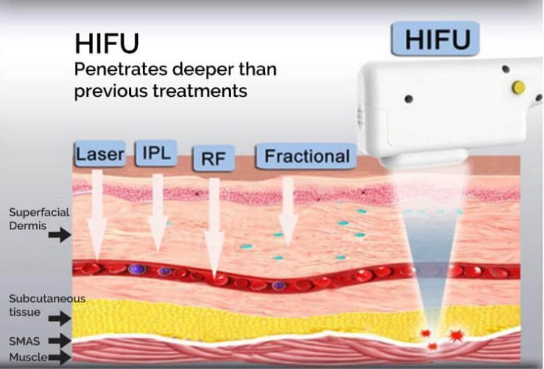 hifu原理